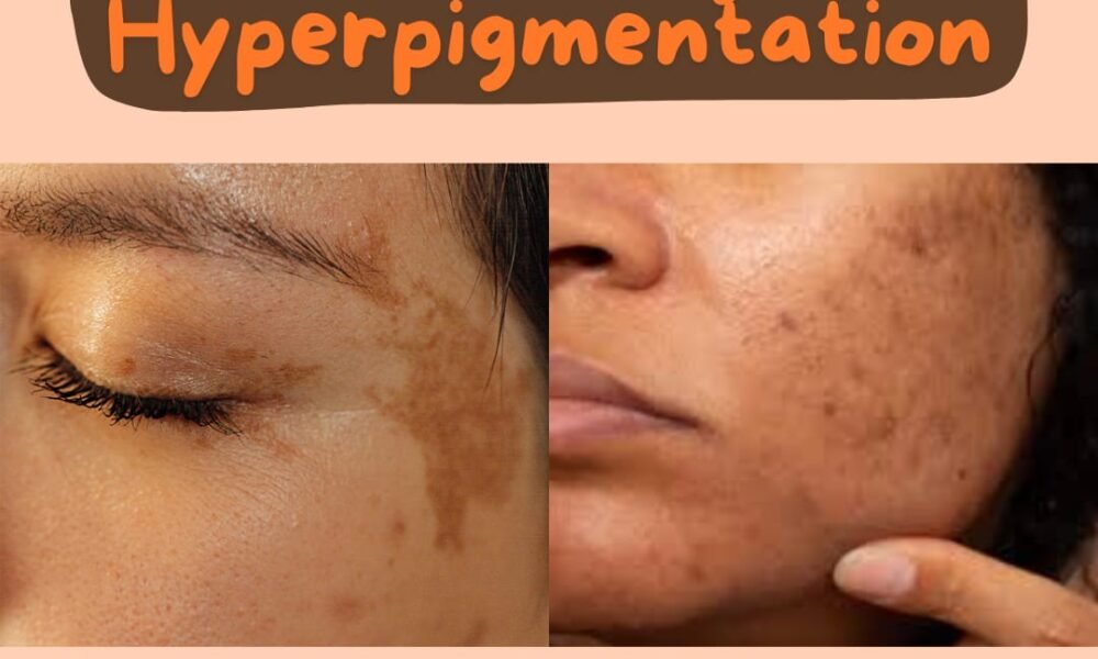 How to Treat Hyperpigmentation Naturally?