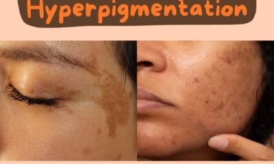 How to Treat Hyperpigmentation Naturally?