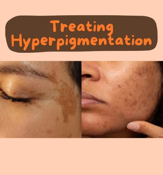 How to Treat Hyperpigmentation Naturally?