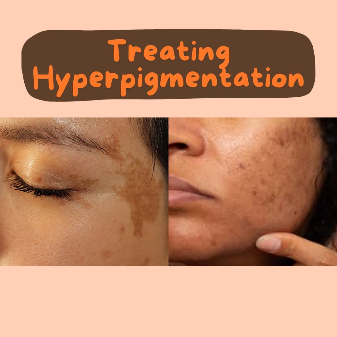 How to Treat Hyperpigmentation Naturally?