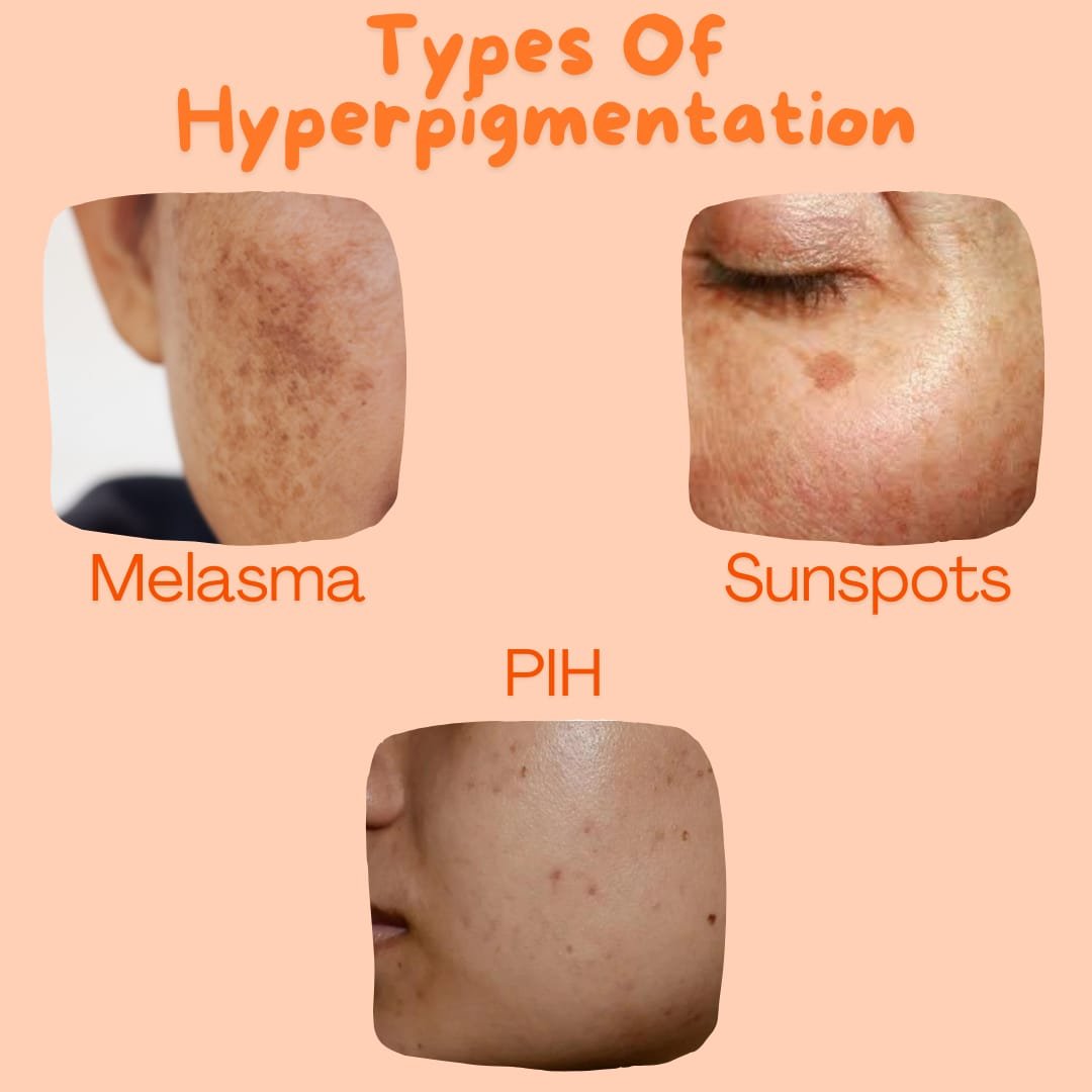 How to Treat Hyperpigmentation Naturally?